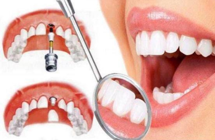 東莞生鮮配送中心為您普及:天生的牙齒和高價(jià)的種植牙哪個(gè)更好?